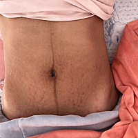 产后一个月二十天了   体重到了119斤就下不去了 很多衣服都穿不了，肚子妊娠纹还有暗沉躺着肚子是平的，...