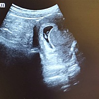 七周5天，宝宝已经有胎心了。就是今天突然孕吐反应不那么明显了，只有一点点恶心，没有吐，话说昨天还吐...