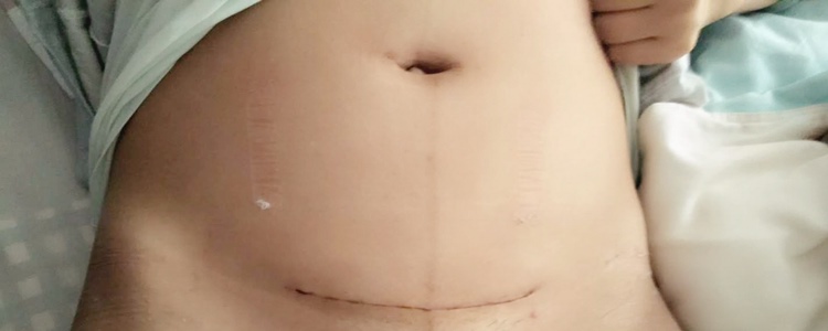 刨宫产后一周摘掉纱布后妈妈给拍的照片！