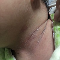 宝宝一出生就有，这是胎记吗？是不是会随着年龄越来越大？