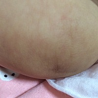 膝关节这儿有个窝，正常吗？宝妈们m