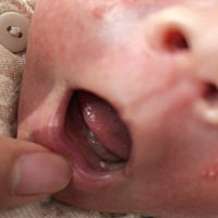 宝宝嘴巴里有个白点是不是烂了 要怎么办