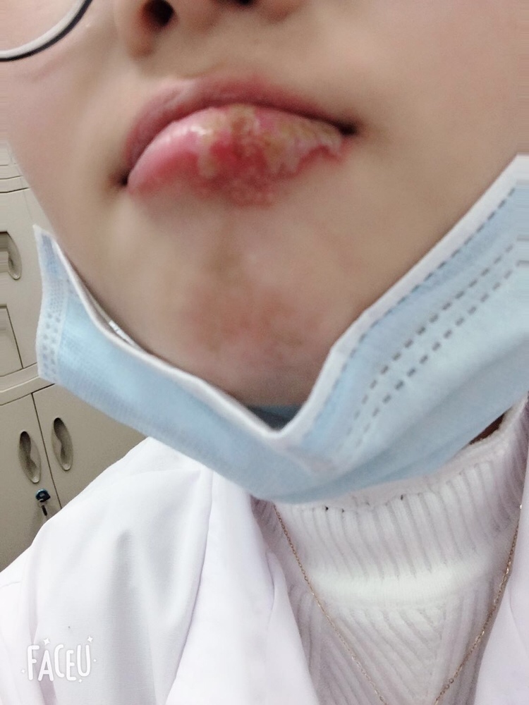 圈内孕妈妈有没有孕期上火严重的？西医说是单纯性疱疹，超级痛痛到淋巴肿大牙痛，泡泡里面是透明的水。