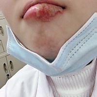 圈内孕妈妈有没有孕期上火严重的？西医说是单纯性疱疹，超级痛痛到淋巴肿大牙痛，泡泡里面是透明的水。