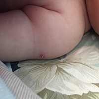 宝宝第一个月打完疫苗胳膊上就结痂了，不知道有没有事，是因为洗澡还是啥原因，怎么处理？不痛不痒的我...