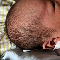 宝宝头上一大片红疹是什么，看着慌…