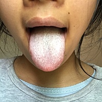 今天是月子里最阳光明媚的一天啦…… 生完孩子舌苔白厚，舌苔有点长毛一样，有没有宝妈这样的情况啊？