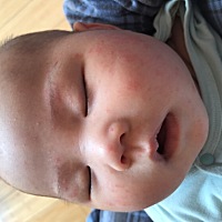 宝宝脸上长了湿疹一个月了 一直不好 眼看就要打第三次疫苗了 不好的话打不了啊 各位宝妈有没有什么办法...