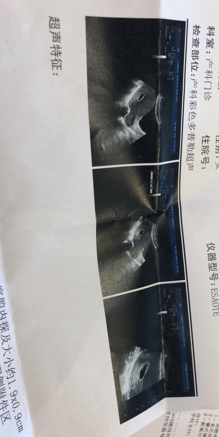 听说初期看Ｂ超孕囊形状和大小就知道男孩女孩，出于好奇就想让会看的亲们帮忙看看，大小是1.9✖️0.9cm，45天时候拍的