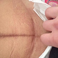 因为没有勇气生，所以直接选择的剖腹产，很幸运遇到好的医生，刀口几乎看不出来……整个孕期胖了50斤，...