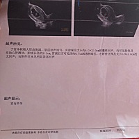 怀孕8周4天这样正常吗 什么是胎心啊