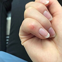 亲们，有没有怀孕期间被宠物狗咬到的，你们都是怎么处理的，18周了，今天不小心让法斗牙齿噌去一小块皮...