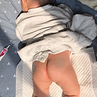 宝宝拉屎非常勤 每次都是一点点屎  擦的屁股都红了 用了屁屁乐也不好 都红了一个星期了 怎么办啊