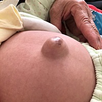 孩子的肚脐这么大有事吗？