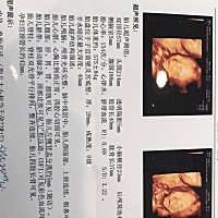 四维彩超有没有会看男女的