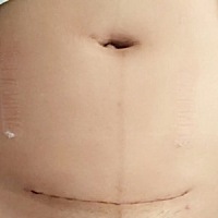 有关孕期孕期涨胎不涨肉的经验可以看我之前的帖子！ 刨宫产手术后一周刚拆纱布！ 刨宫产术后20天！