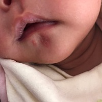 宝宝下巴这里长得是湿疹吗？刚开始只有一个，一夜之间多了好几个。