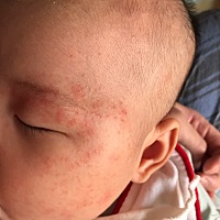 各位宝妈用过婴宝吗？到底有没有激素 我家宝贝脸上长湿疹别人推荐用婴宝 但也有人说含激素不敢用