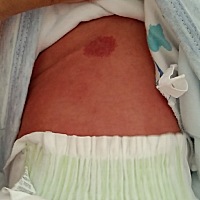 宝宝身上不知道这是长的什么，有没有人帮帮我，刚刚出生时没这么红