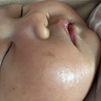 有没有宝妈知道宝宝脸蛋儿上这块印记是什么，刚生下来没有，由于宝宝刚生下来有黄疸，不明显，过了七八...
