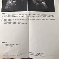 宝妈们急死我了，今天去做b超医生说我右侧附件有混合性包块，之前做b超也没有。想问问有没有和我一样的...