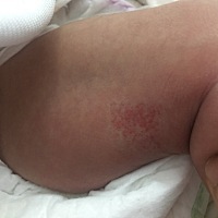 宝宝大腿后侧长了血管瘤，越来越明显了，咋整，不知道广州哪个医院有外用的药，心疼死了