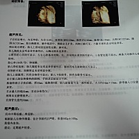 今天去做四维，检查结果提示胎盘内血池，这个严重吗？如何看男孩女孩