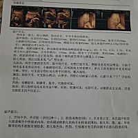 宝宝已经二十四天了   八斤六的一个女宝😊😊