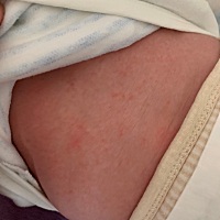 宝宝脖子，胸前，服装都长了这些，用什么办法可以消除呀，这是属于什么原因造成的？求帮助