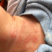 宝宝快2个半月了，近期脖子处长了一大片疙瘩，不知是不是湿疹，应该怎么处理？谢谢有经验的宝妈帮看看。