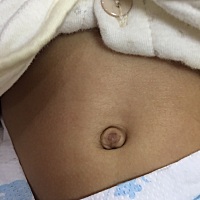 宝贝的肚脐眼怎么陷不到里面去，绑肚脐绑了还是这样的，宝妈们有什么办法吗？