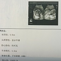 4个月没感觉到胎动  一直在担心   今天孕检一切正常    宝宝很健康   二胎希望儿女双全