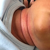 这是热出来的吗？痱子？先是脖子后面长了，现在脖子前面也长了😩😩头后面也红了一点，，长了一点