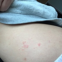 生完孩子以后皮肤经常痒，坐月子的时候得过寻麻疹，好了以后，过段时间身上又痒了一抓摸起来就有很多疙...