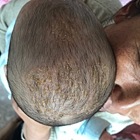 两个月宝宝脂溢性皮炎。面积还在扩大。医院开了药膏含激素 能用吗