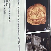 预产期十月十号的，现在每天除了吐就是难受已经都十四周了，十三周去做的NT，吐成这样吃不下饭去，医生...