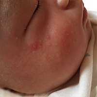 宝妈们，我家宝宝一个月了，我宝脸上，两个腿腿上，后背上，头上，脖子上都有，宝宝穿的不多就一件上衣...