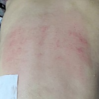 感冒了，连续发烧三天。晚上下班去开药，医生说只能喝中药，只好喊老公刮了个背。