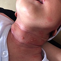 请问各位宝妈，现在宝宝33天了脖子上长的这个是什么啊？怎么办？宝宝现在睡觉都睡不好