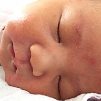 请教宝妈们 宝宝脸上长了红色的点点 集中在眉毛附近 是湿疹么 还是我吃咸了呢