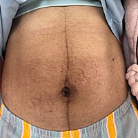 刚生完宝宝，肚皮又黑又松弛皱巴巴的。自己都不忍直视啊～ 🤪 想问一下有经验的宝妈，之后会慢慢恢复...