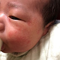 我女儿1个月4天了，这脸上起了这些痘痘是什么，哪位准麻麻知道？