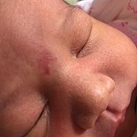 宝宝额头的红色不会是胎记吧？ 几天了意外没消 怎么办啊 急求。