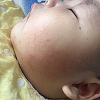 宝宝脸上突然起了这么些疹子，也不知道是怎么回事？不像是热的，之前热吃的疹子主要凉快了就能退，但是...
