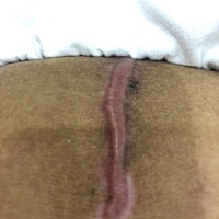 破腹产三个多月的刀口，你们是这样吗？应该怎么养呢？