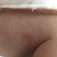 确定是血管瘤了，本来只有粉红色，一个礼拜就变深红色了，而且变得也比较厚，宝宝才十八天，今天就带她...
