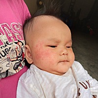 反反复复的出。一会快好了，第二天又很红很红。两边脸颊都一样。下巴脖子也有一点，看着都揪心。擦啥都...