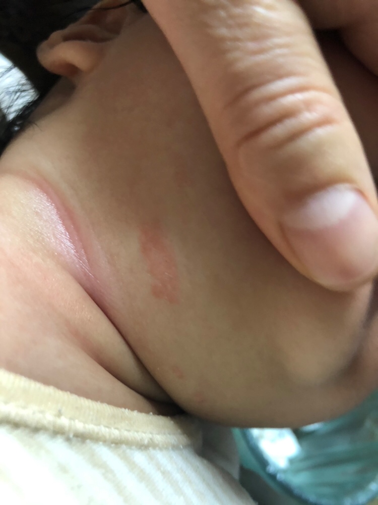 这红了一块的是什么呀 自从游泳回来后就有了 好几天都没消