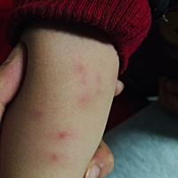 二宝身上长的不知道是什么，先是出红点，会痒，然后就是水泡一样的痘痘，