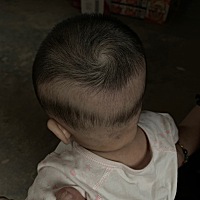 宝宝头上这一圈头发没有长，是有什么问题吗？出生到现在都这样。